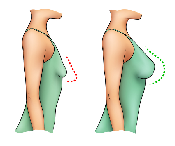 chirurgie esthétique des seins clinique le bardo